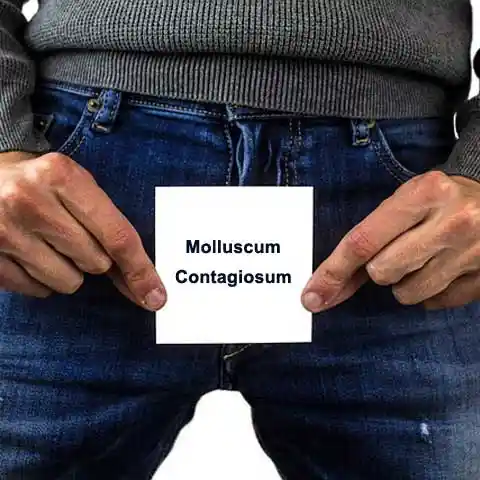 Molluscum-Contagiosum-Treatment in Delhi