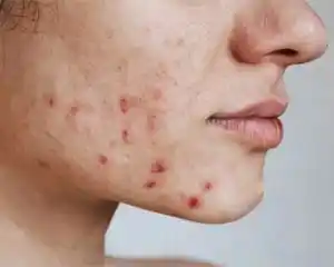 Acne treatment by skin doctor