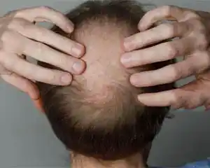 Hair Loss solution for men and woman 