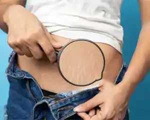 Stretch Marks