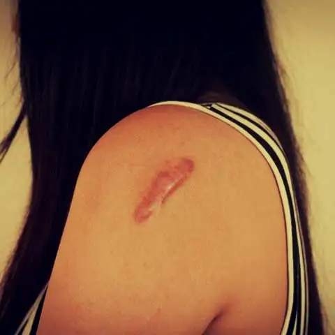 Keloid Specialist Doctor in Delhi