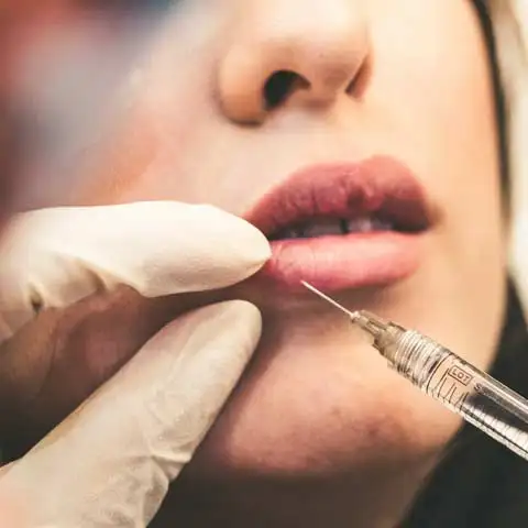 Lip Augmentation Doctor in Delhi for lip augmentation treatment