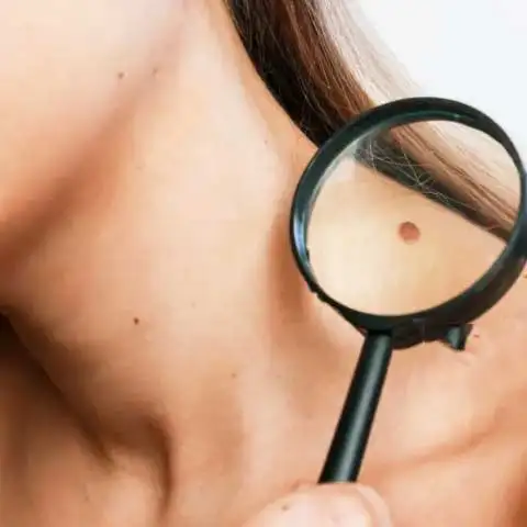 mole removal Specialist Doctor in Delhi