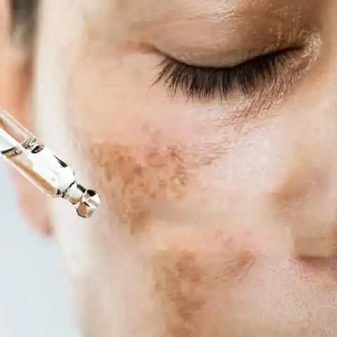 Pigmentation/melasma Specialist Doctor in Delhi