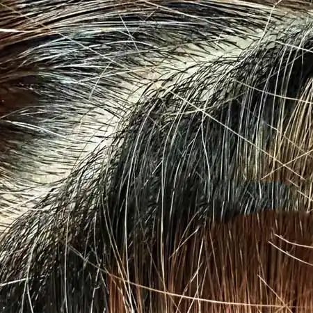 grey white hair Specialist Doctor in Delhi for premature greying