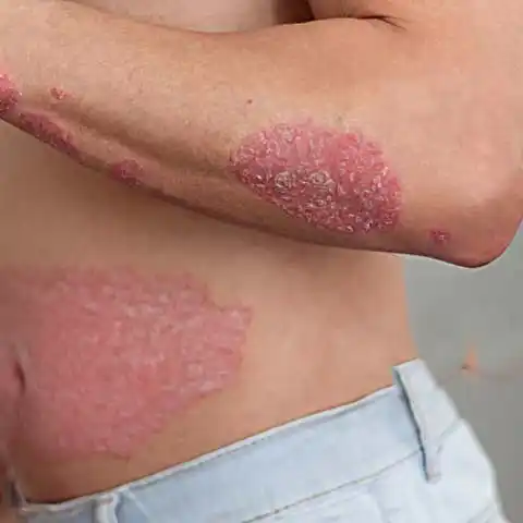 Psoriasis Specialist Doctor in Delhi