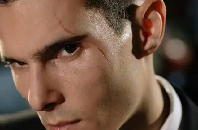 Scar revision treatment in Delhi by Dr. Navin Taneja at The National Skin Centre