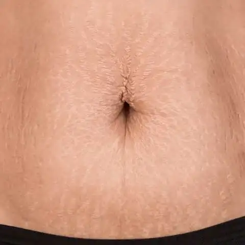 Stretch marks removal treatment in Delhi for smooth skin