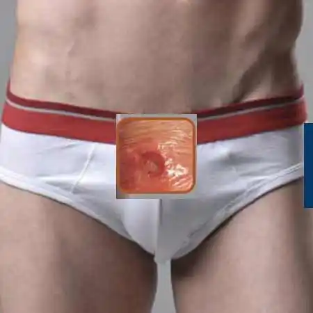 Syphilis treatment Specialist Doctor in Delhi