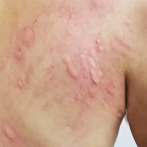 Urticaria Specialist Doctor in Delhi