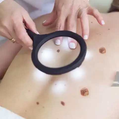 Warts removal treatment specialist Doctor in Delhi